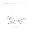 MINIMALLY INVASIVE BREAST LIFT METHOD WITH A SUPERIOR TISSUE SUPPORT AND AN INFERIOR ANCHOR diagram and image