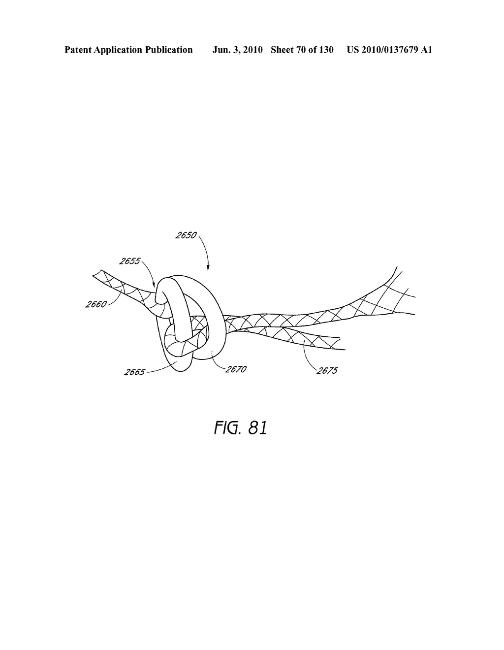 MINIMALLY INVASIVE BREAST LIFT METHOD WITH A SUPERIOR TISSUE SUPPORT AND AN INFERIOR ANCHOR - diagram, schematic, and image 71