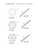 MINIMALLY INVASIVE BREAST LIFT METHOD WITH A SUPERIOR TISSUE SUPPORT AND AN INFERIOR ANCHOR diagram and image