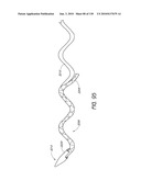 MINIMALLY INVASIVE BREAST LIFT METHOD WITH A SUPERIOR TISSUE SUPPORT AND AN INFERIOR ANCHOR diagram and image