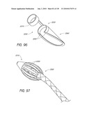 MINIMALLY INVASIVE BREAST LIFT METHOD WITH A SUPERIOR TISSUE SUPPORT AND AN INFERIOR ANCHOR diagram and image