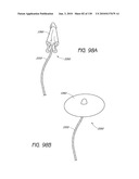 MINIMALLY INVASIVE BREAST LIFT METHOD WITH A SUPERIOR TISSUE SUPPORT AND AN INFERIOR ANCHOR diagram and image