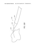 MINIMALLY INVASIVE BREAST LIFT METHOD WITH A SUPERIOR TISSUE SUPPORT AND AN INFERIOR ANCHOR diagram and image