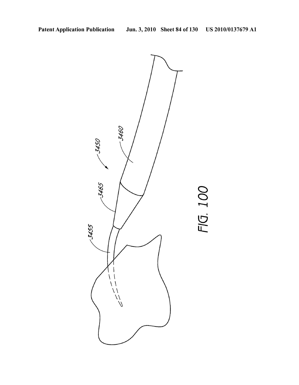 MINIMALLY INVASIVE BREAST LIFT METHOD WITH A SUPERIOR TISSUE SUPPORT AND AN INFERIOR ANCHOR - diagram, schematic, and image 85