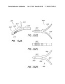 MINIMALLY INVASIVE BREAST LIFT METHOD WITH A SUPERIOR TISSUE SUPPORT AND AN INFERIOR ANCHOR diagram and image