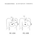 MINIMALLY INVASIVE BREAST LIFT METHOD WITH A SUPERIOR TISSUE SUPPORT AND AN INFERIOR ANCHOR diagram and image