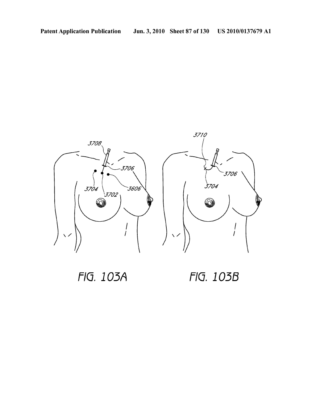 MINIMALLY INVASIVE BREAST LIFT METHOD WITH A SUPERIOR TISSUE SUPPORT AND AN INFERIOR ANCHOR - diagram, schematic, and image 88