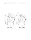 MINIMALLY INVASIVE BREAST LIFT METHOD WITH A SUPERIOR TISSUE SUPPORT AND AN INFERIOR ANCHOR diagram and image