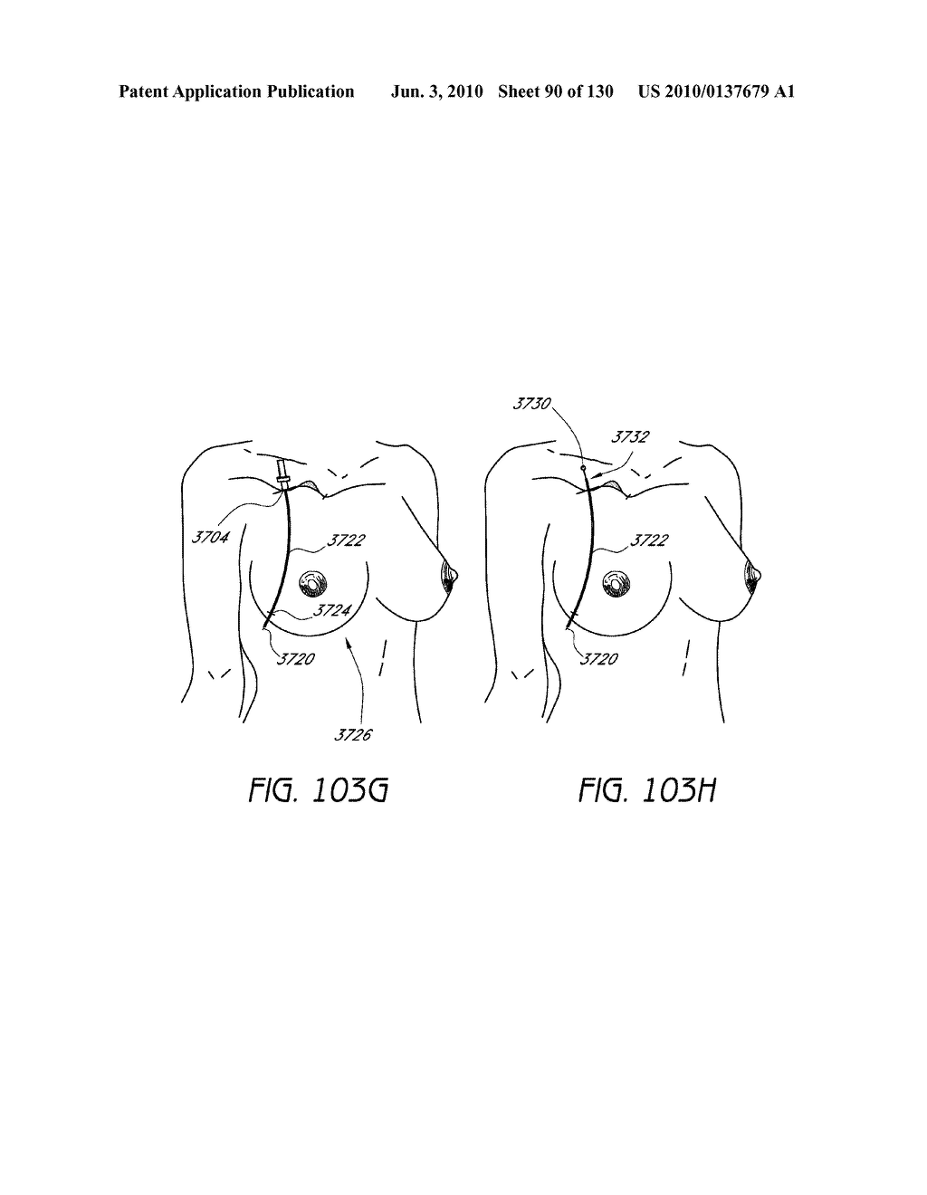 MINIMALLY INVASIVE BREAST LIFT METHOD WITH A SUPERIOR TISSUE SUPPORT AND AN INFERIOR ANCHOR - diagram, schematic, and image 91