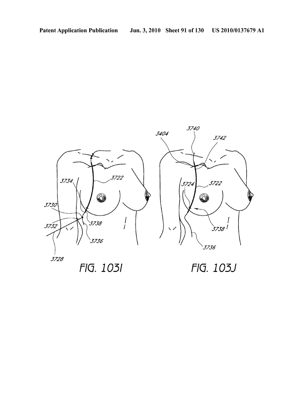 MINIMALLY INVASIVE BREAST LIFT METHOD WITH A SUPERIOR TISSUE SUPPORT AND AN INFERIOR ANCHOR - diagram, schematic, and image 92