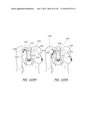 MINIMALLY INVASIVE BREAST LIFT METHOD WITH A SUPERIOR TISSUE SUPPORT AND AN INFERIOR ANCHOR diagram and image