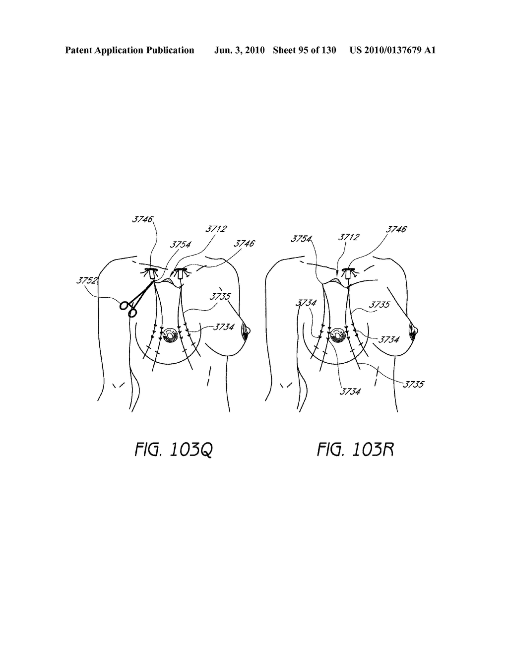 MINIMALLY INVASIVE BREAST LIFT METHOD WITH A SUPERIOR TISSUE SUPPORT AND AN INFERIOR ANCHOR - diagram, schematic, and image 96