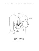 MINIMALLY INVASIVE BREAST LIFT METHOD WITH A SUPERIOR TISSUE SUPPORT AND AN INFERIOR ANCHOR diagram and image