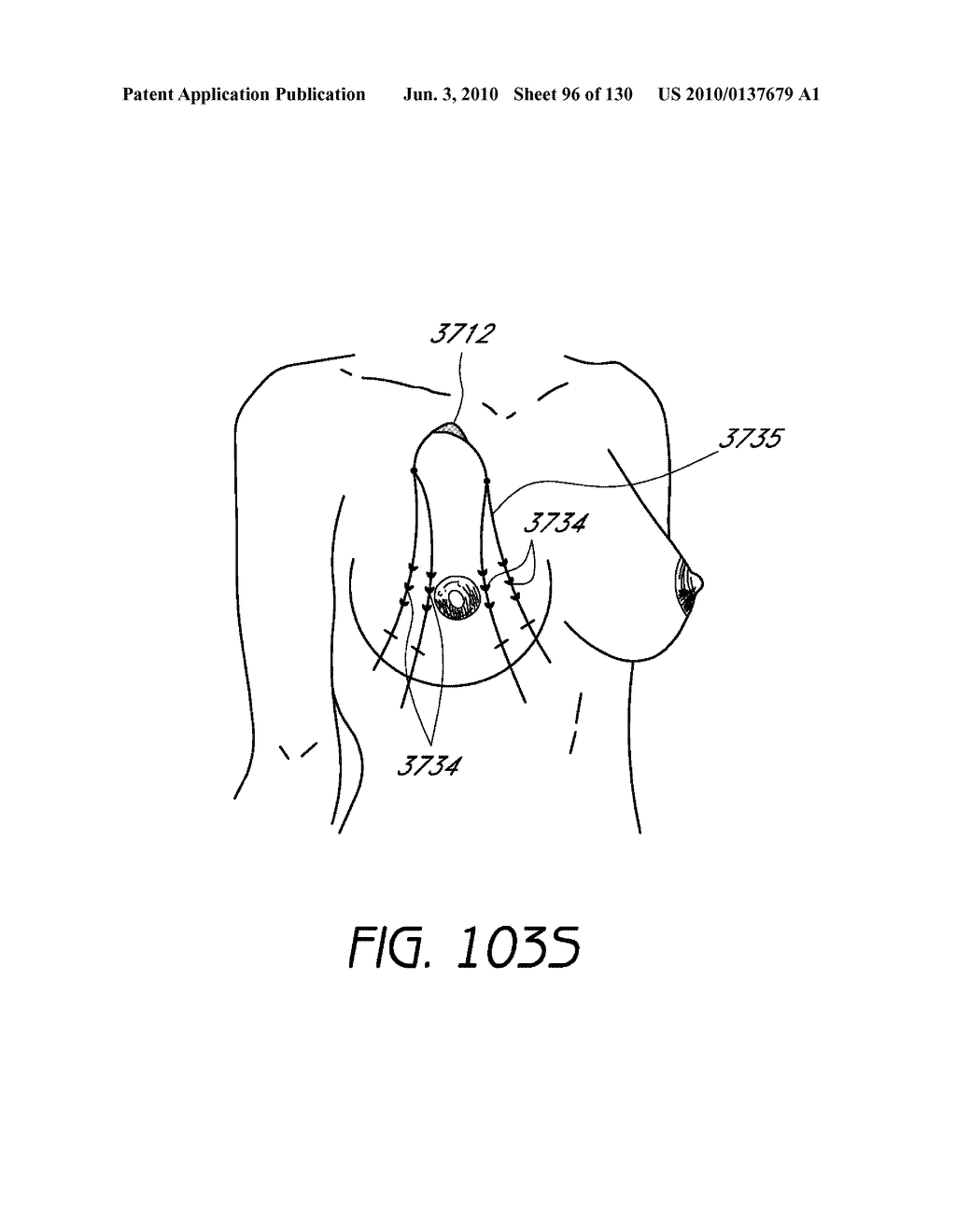 MINIMALLY INVASIVE BREAST LIFT METHOD WITH A SUPERIOR TISSUE SUPPORT AND AN INFERIOR ANCHOR - diagram, schematic, and image 97