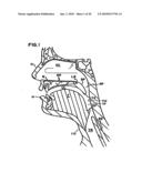 Pharyngeal wall treatment diagram and image