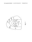 Pharyngeal wall treatment diagram and image