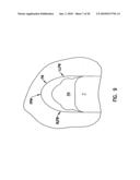 Pharyngeal wall treatment diagram and image