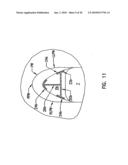 Pharyngeal wall treatment diagram and image