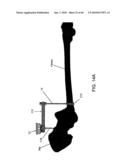 HIP SURGERY SYSTEMS AND METHODS diagram and image