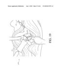 HIP SURGERY SYSTEMS AND METHODS diagram and image