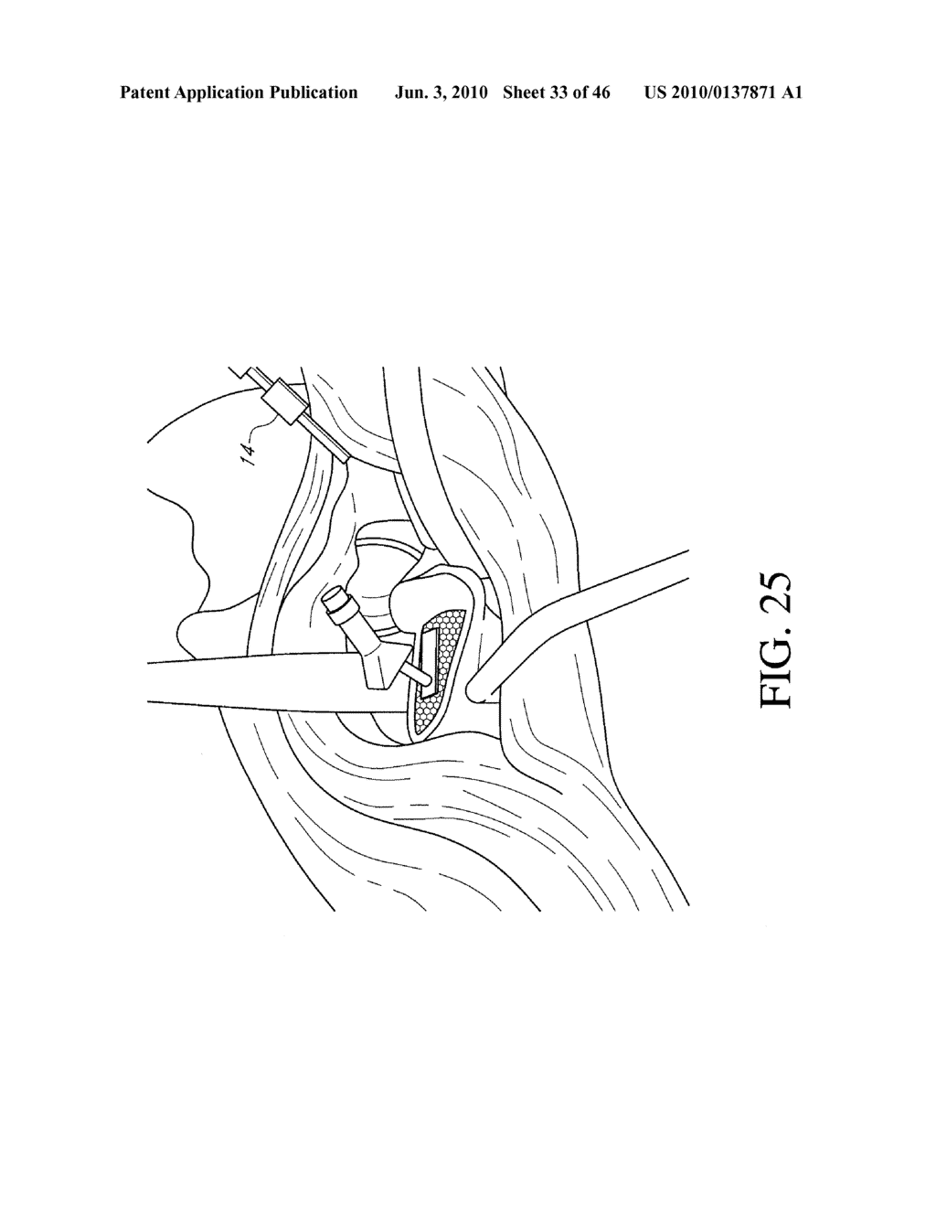 HIP SURGERY SYSTEMS AND METHODS - diagram, schematic, and image 34