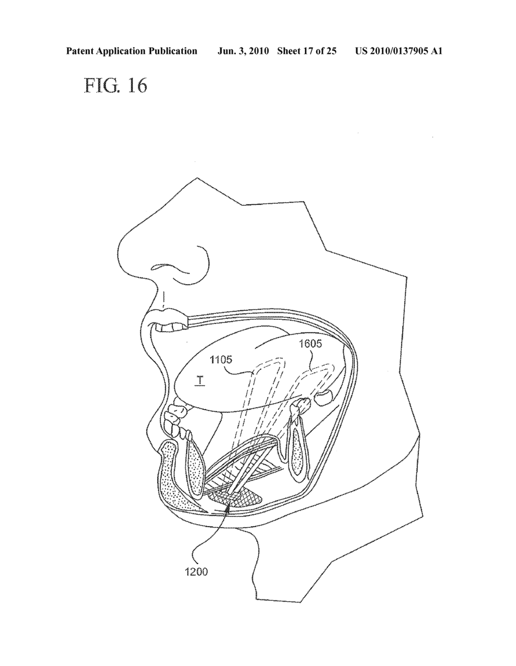 IMPLANT SYSTEMS AND METHODS FOR TREATING OBSTRUCTIVE SLEEP APNEA - diagram, schematic, and image 18