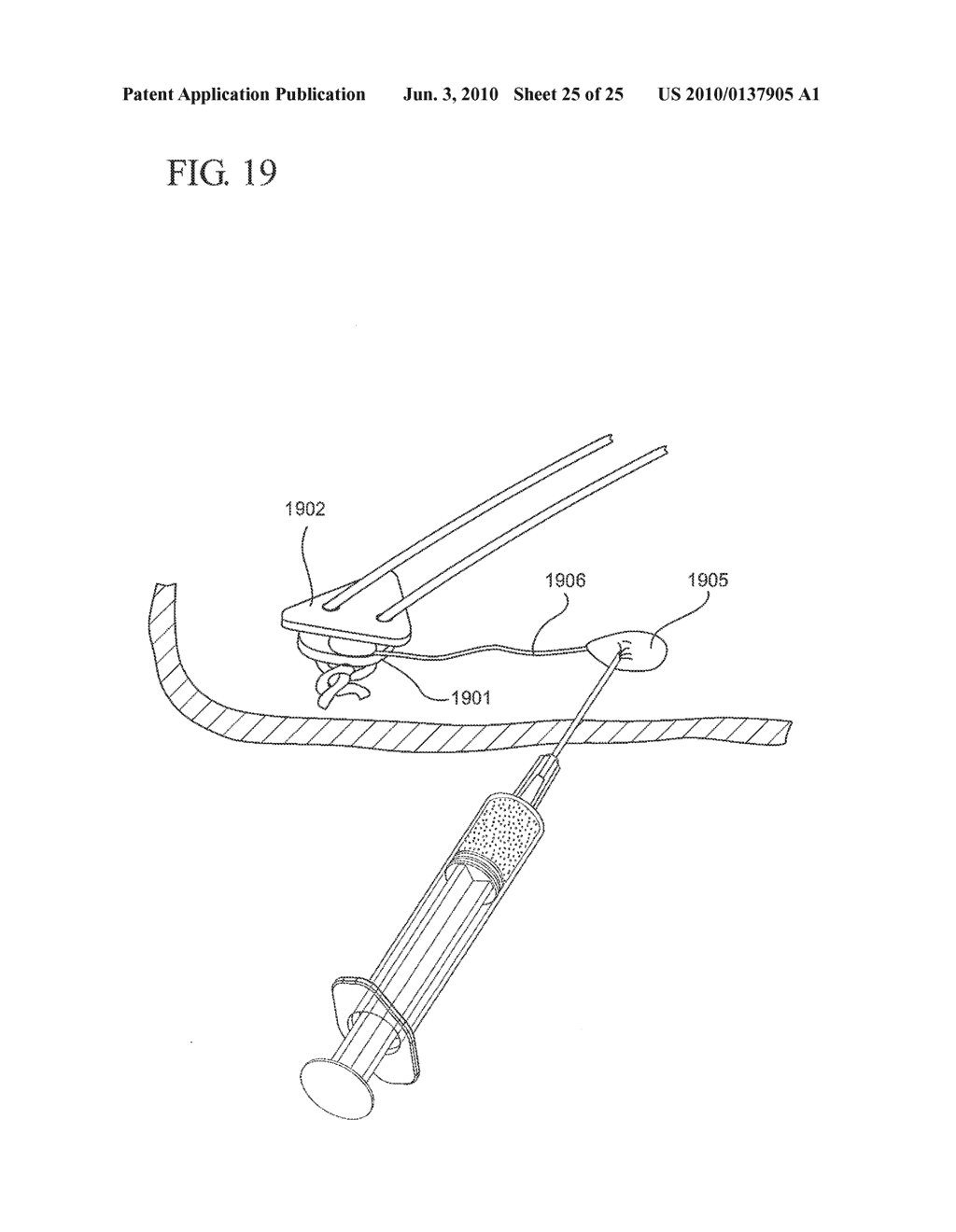 IMPLANT SYSTEMS AND METHODS FOR TREATING OBSTRUCTIVE SLEEP APNEA - diagram, schematic, and image 26