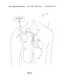 IMPLANTABLE MEDICAL DEVICE INCLUDING A PLURALITY OF LEAD CONNECTION ASSEMBLIES diagram and image