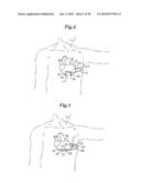 Subcutaneous Electrode with Improved Contact Shape for Transthoracic Conduction diagram and image