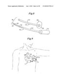 Subcutaneous Electrode with Improved Contact Shape for Transthoracic Conduction diagram and image