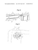 Subcutaneous Electrode with Improved Contact Shape for Transthoracic Conduction diagram and image