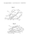 Subcutaneous Electrode with Improved Contact Shape for Transthoracic Conduction diagram and image