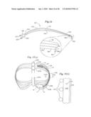 Subcutaneous Electrode with Improved Contact Shape for Transthoracic Conduction diagram and image