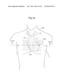 Subcutaneous Electrode with Improved Contact Shape for Transthoracic Conduction diagram and image