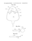 Subcutaneous Electrode with Improved Contact Shape for Transthoracic Conduction diagram and image