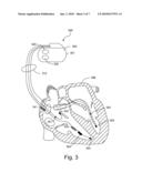 Implantable Cardiac Device With Dyspnea Measurement diagram and image