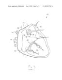 BIFURCATED ELECTRICAL LEAD AND METHOD OF USE diagram and image