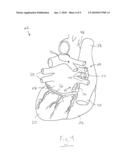 BIFURCATED ELECTRICAL LEAD AND METHOD OF USE diagram and image