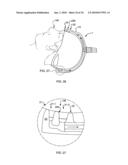 METHOD AND APPARATUS FOR REDUCING BODY TEMPERATURE OF A SUBJECT diagram and image