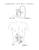 APPARATUSES FOR THERMALLY-INDUCED RENAL NEUROMODULATION diagram and image