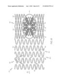 Stent with Graduated Stiffness diagram and image