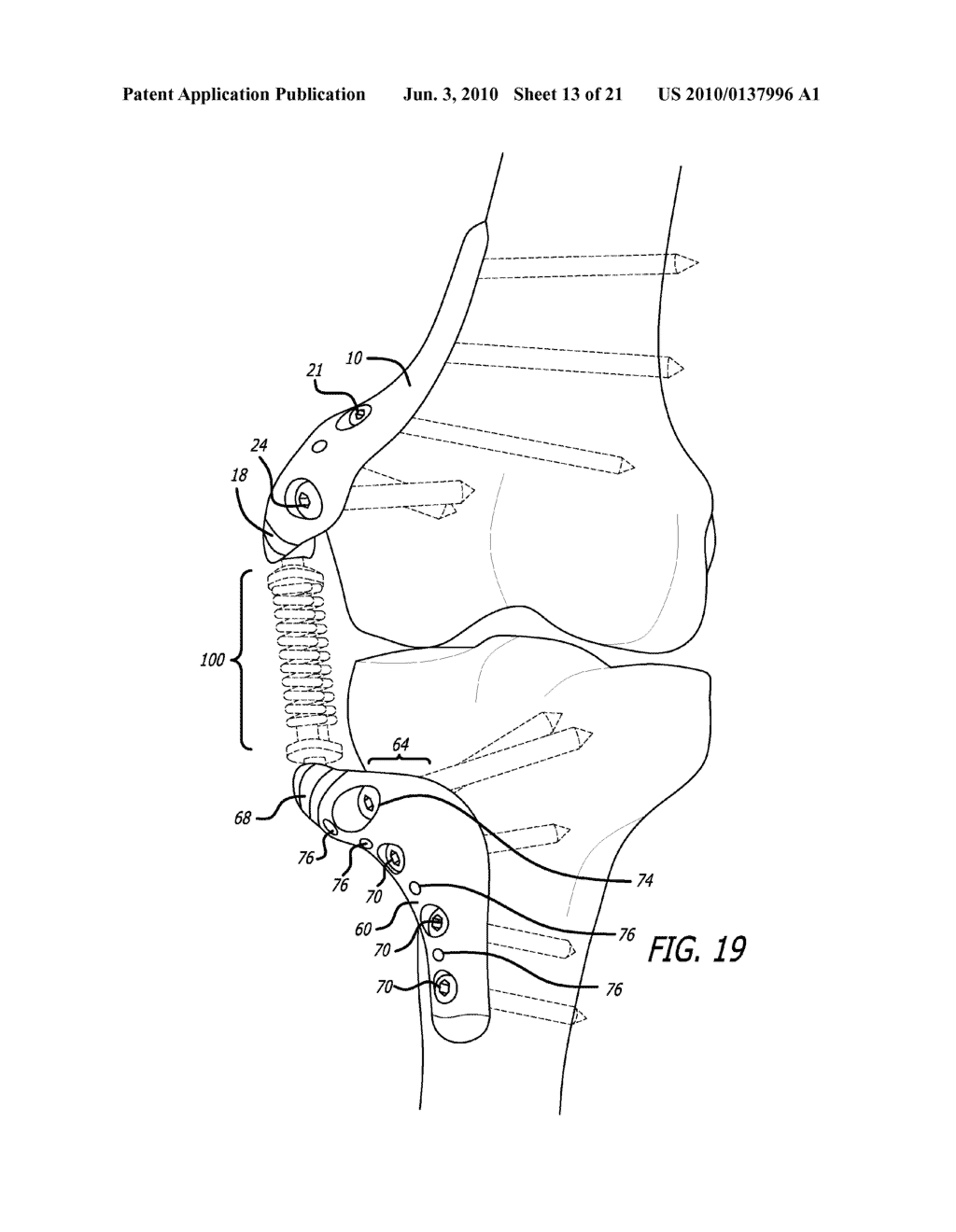 FEMORAL AND TIBIAL BASE COMPONENTS - diagram, schematic, and image 14