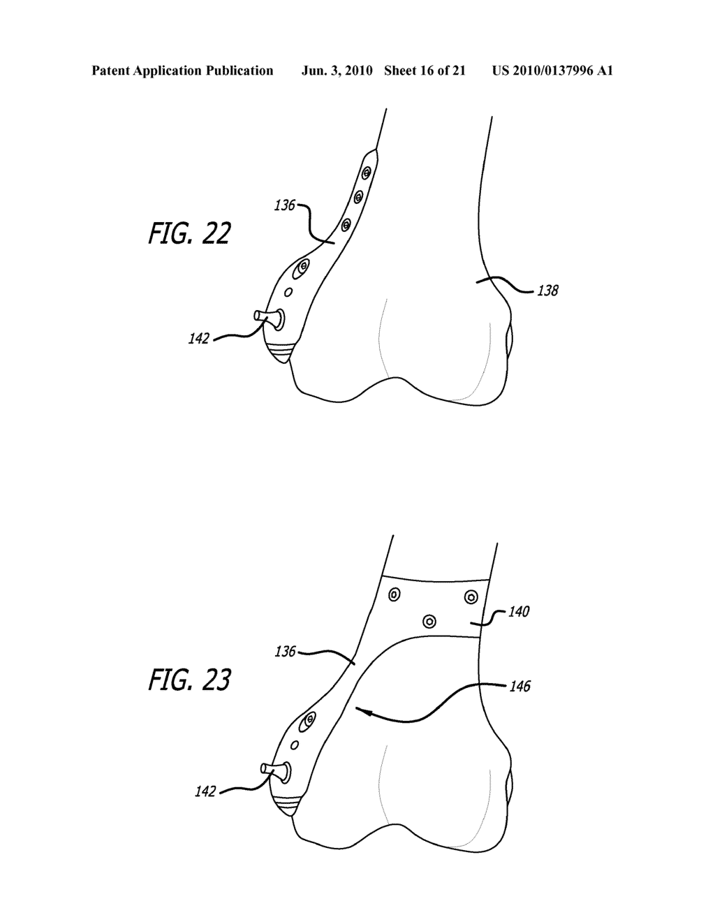 FEMORAL AND TIBIAL BASE COMPONENTS - diagram, schematic, and image 17