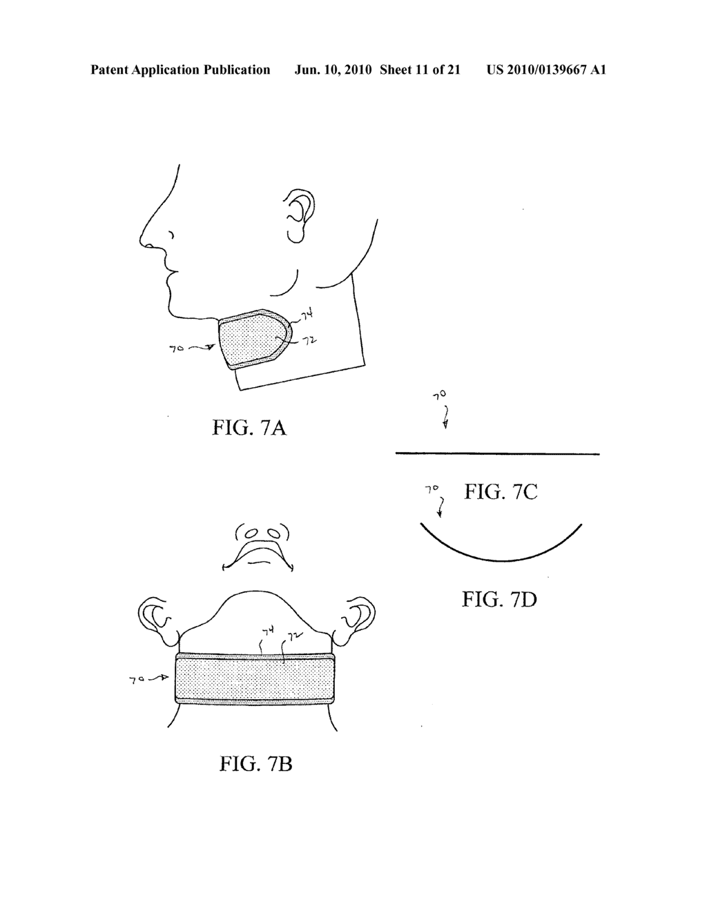 DEVICES AND METHODS FOR TREATING SLEEP DISORDERS - diagram, schematic, and image 12