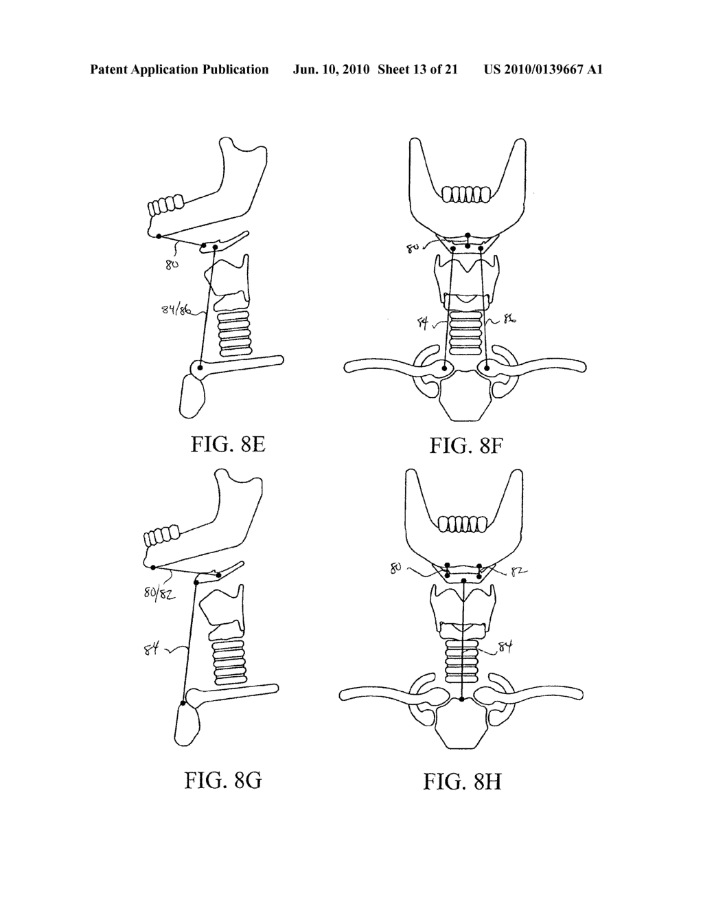 DEVICES AND METHODS FOR TREATING SLEEP DISORDERS - diagram, schematic, and image 14