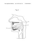 Method and Device For Treatment Of Obstructive Sleep Apnea diagram and image