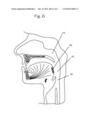 Method and Device For Treatment Of Obstructive Sleep Apnea diagram and image