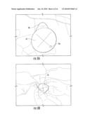 SURGICAL DRAPES WITH PATCHES TO PROVIDE PORTS diagram and image