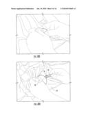 SURGICAL DRAPES WITH PATCHES TO PROVIDE PORTS diagram and image