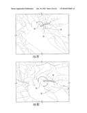 SURGICAL DRAPES WITH PATCHES TO PROVIDE PORTS diagram and image